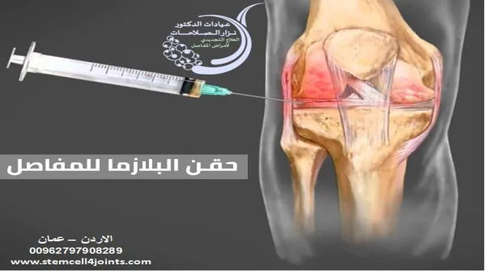 حقن البلازما للركبة: العلاج الآمن للآلام