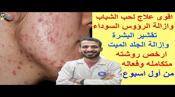 علاج حب الشباب: روشتة فعالة ومجربة