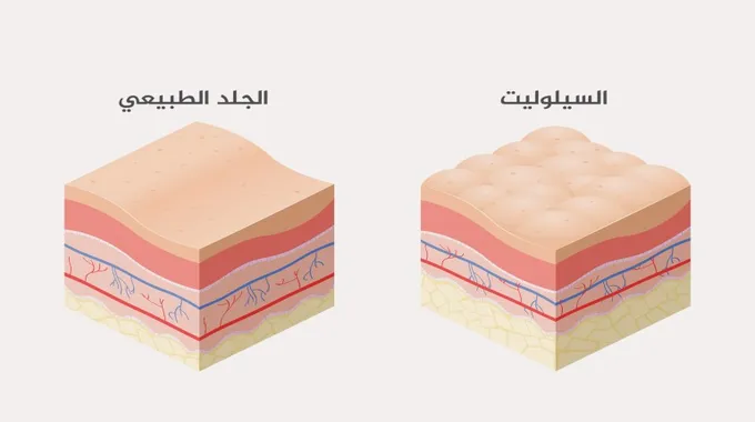 كل ما تحتاج معرفته عن السيلوليت